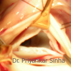 Aortic valve repair, surgical evaluation of the valve