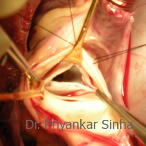 Aortic valve repair, surgical evaluation of the valve