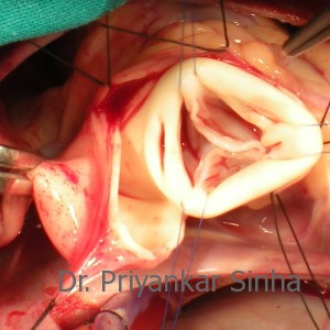 Aortic valve repair, suspension of the commissures