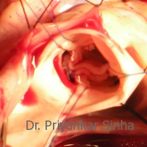 Aortic valve repair, repair in progress