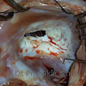 Rheumatic Tricuspid valve stenosis (TS), the orifice is narrowed with thickened leaflets