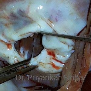 Rheumatic Tricuspid valve stenosis (TS), showing the fused commissures between the leaflets
