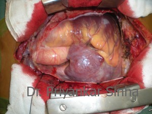 A typical “ASD heart”