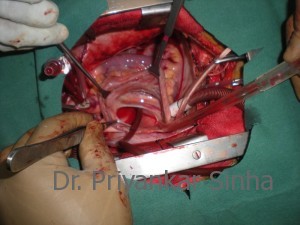 The right atrium has been opened showing the ostium secundum ASD