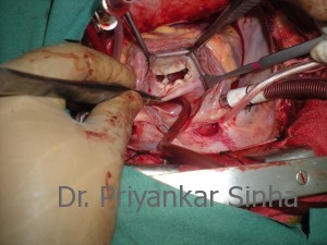 The dysfunctional mitral valve as seen through the ASD. There is an obvious cleft with thickened subvalvar apparatus at the P1 – P2 junction