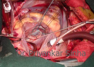 A beautifully competent mitral valve on testing. This valve will be good for a very very long time! It is a cure!