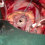 The repaired mitral valve with a complete rigid shaped ring