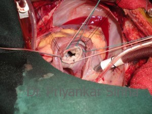 The repaired mitral valve with a complete rigid shaped ring