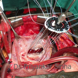 Rheumatic Tricuspid Regurgitation (TR), a reducing ring annuloplasty with a flexible ring
