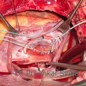 Rheumatic Tricuspid Regurgitation (TR), a reducing ring annuloplasty with a flexible ring with a competent tricuspid valve on testing