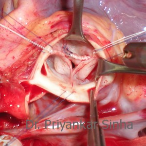 Aortic valve repair, fully repaired valve with suspended cusps