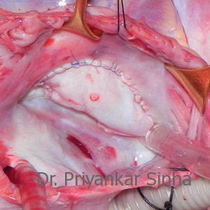 Tricuspid Valve having been reconstructed from the patient’s own tissues