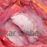 Tricuspid Valve having been reconstructed from the patient’s own tissues