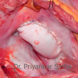 Tricuspid Valve having been reconstructed from the patient’s own tissues