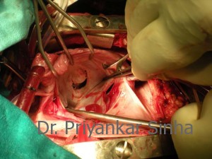 Rheumatic mitral regurgitation with prolapse of the anterior mitral valve leaflet and dilated posterior annulus