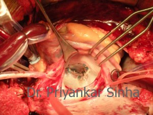 Competent post repair mitral valve