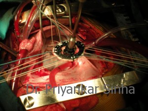 Rheumatic MR, following repair a flexible ring is being placed