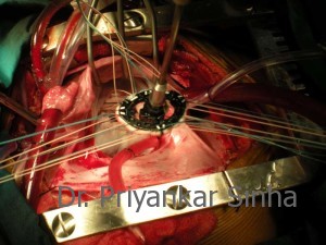 Following repair the ring being placed