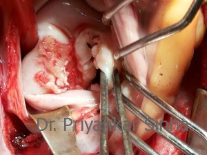 Rheumatic mitral regurgitation, MR with a large “jet lesion”