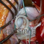 Rheumatic MR, a beautifully competent mitral valve with a rigid shaped ring in situ.