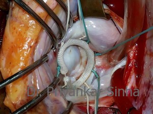 Rheumatic MR, a beautifully competent mitral valve with a rigid shaped ring in situ.