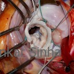 Rheumatic MR, a widely open repaired mitral valve.