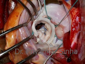 Rheumatic MR, a widely open repaired mitral valve.