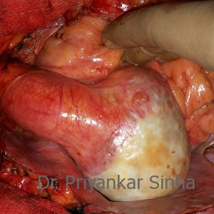 Aneurysm of the sinus and proximal ascending aorta
