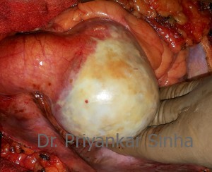 Aneurysm of the sinus and proximal ascending aorta