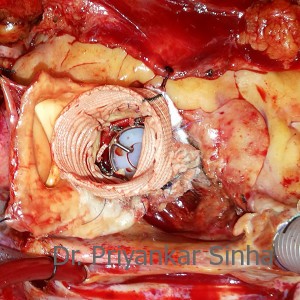 Replacement of the proximal segment with a synthetic tube graft with aortic valve replacement
