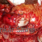 Replaced Aorta at the end of surgery