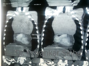 CT scan showing the mediastinal tumor