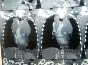 Contrast CT scan showing the Aorta and the head and neck arteries in relation to the tumor