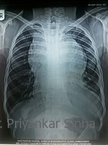 Ray of the chest showing a huge mediastinal tumor