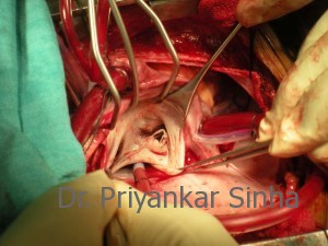 Ruptured chords to the posterior mitral leaflet