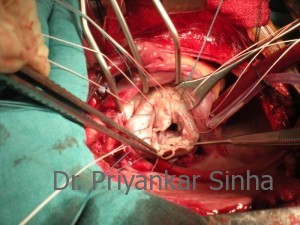 Prolapsing posterior leaflet and ruptured chords to the area