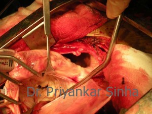 Degenerative mitral valve with severe prolapse of the central part of the posterior leaflet