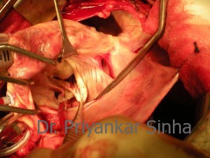 A valve examination demonstrates the severity of the prolapse of the posterior leaflet.