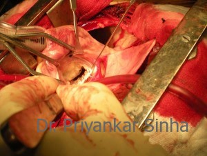 The prolapsed part is totally devoid of chordal support.