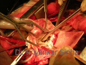 The diseased portion of the leaflet is excised.