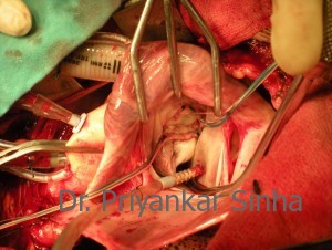 A beautifully competent mitral valve with a flexible ring.