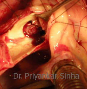 Infective endocarditis of the Aortic valve