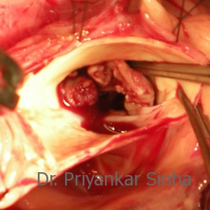 The infective material / vegetations being removed