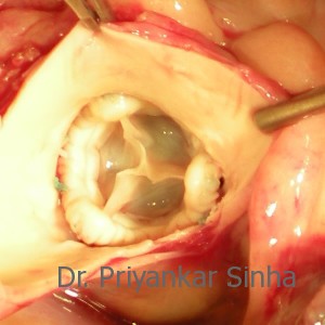 Totally cleaned Aorta with a new Aortic valve