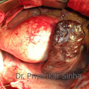 A dilated aortic root