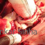 Replacement of the root with the composite graft