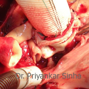 Replacement of the root with the composite graft