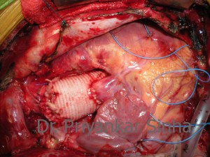 The final result. A completely replaced root.