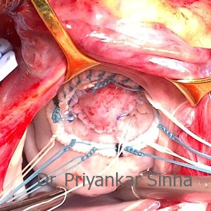 Mitral valve reconstructed with the patient’s own pericardium