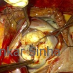 Rheumatic mitral stenosis with thick leaflets and fused subvalvar apparatus severely narrowing the orifice